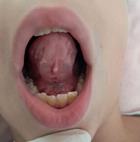 skrócone wędzidełko języka