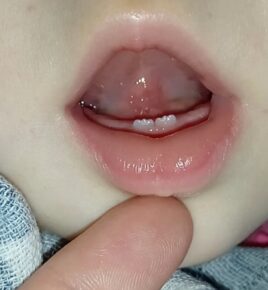 skrócone wędzidełko języka