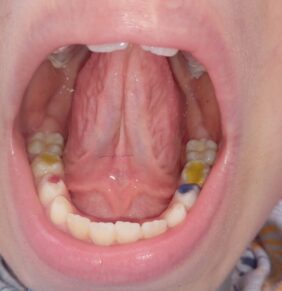 skrócone wędzidełko języka